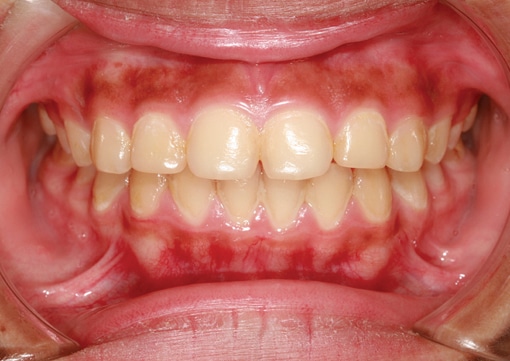 Gum Disease Therapy in Lindsay