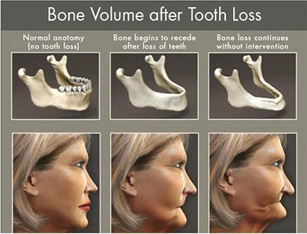 Bone volume after tooth loss