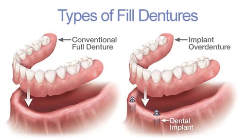 Dentures